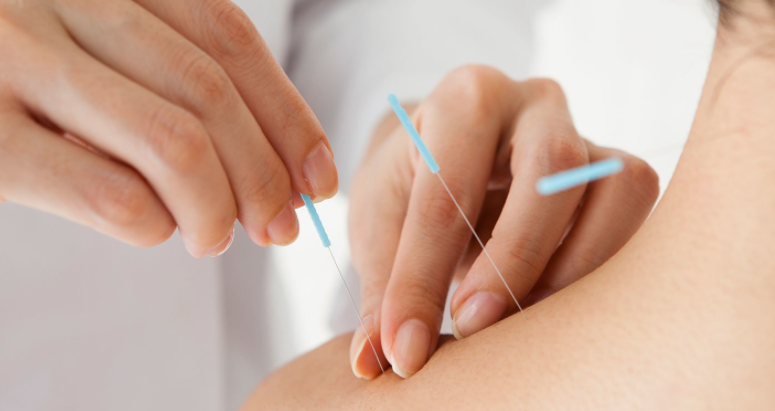 Acupuncture benefits