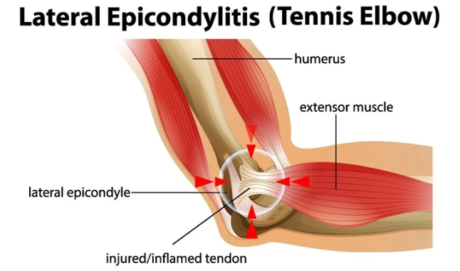 Tennis Elbow Burnaby